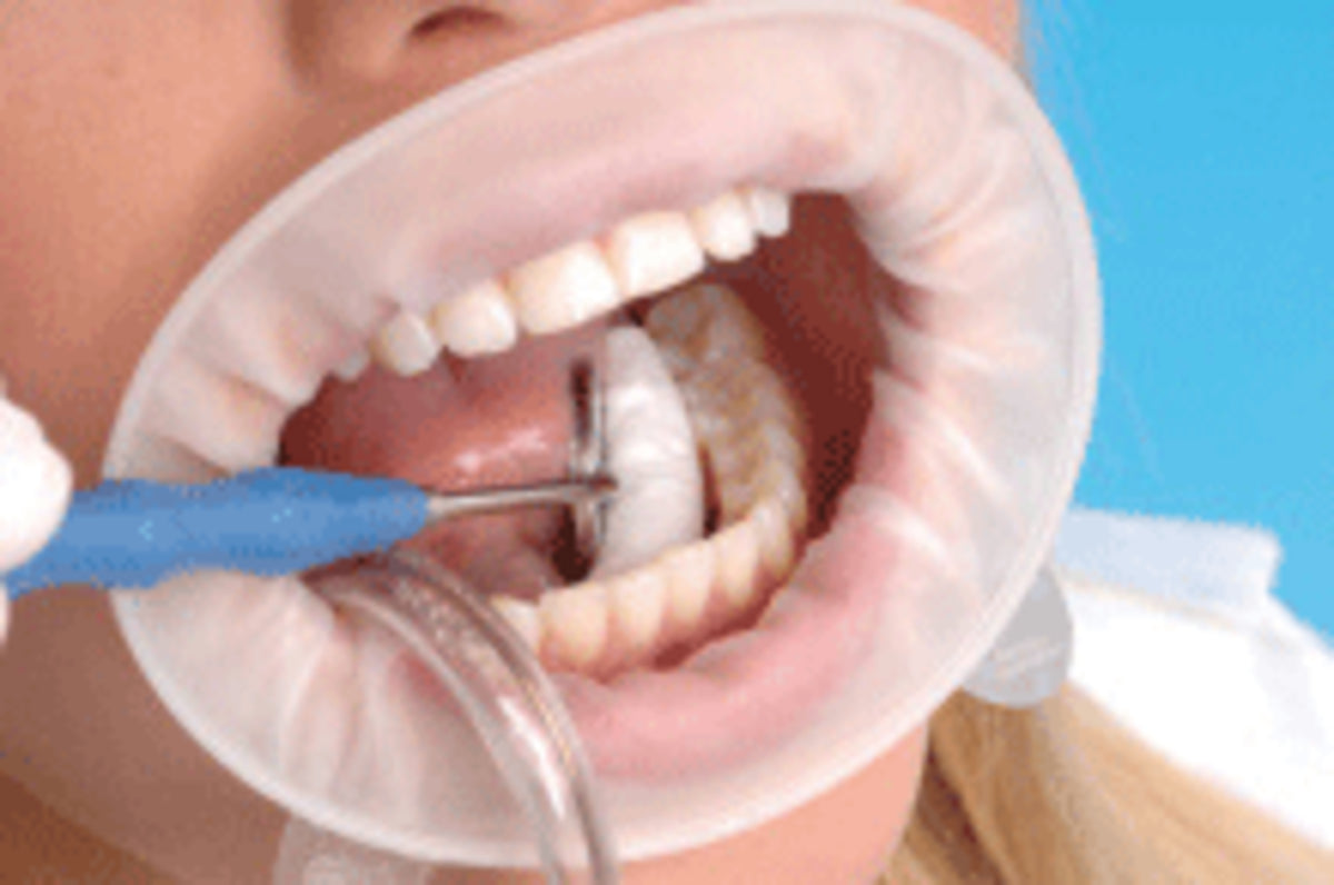 Ivoclar Vivadent 590851 OptraGate 3D Lip & Cheek Retractor Adult Small 80/Bx Ivoclar Vivadent 590851 OptraGate 3D Lip & Cheek Retractor Adult Small 80/Bx